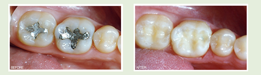 Get White Dental Fillings in Coral Gables & Miami - South Gables Dental