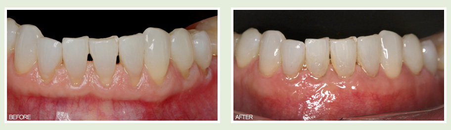 Metal Free Dental Implants